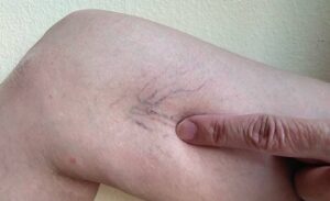 varicose vein removal Adelaide