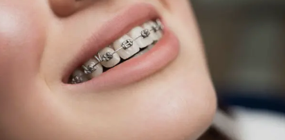 dental braces Adelaide